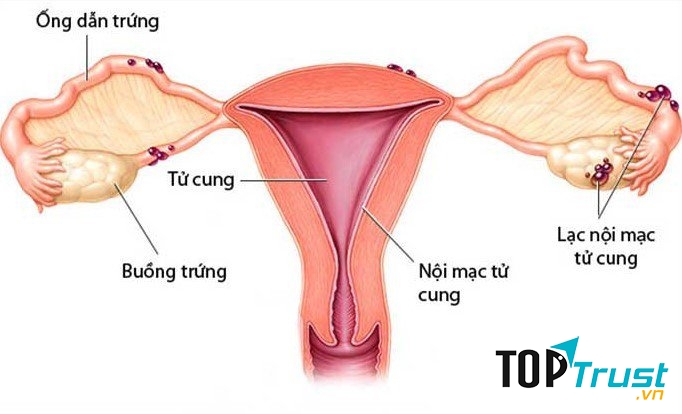 Bị lạc nội mạc tử cung