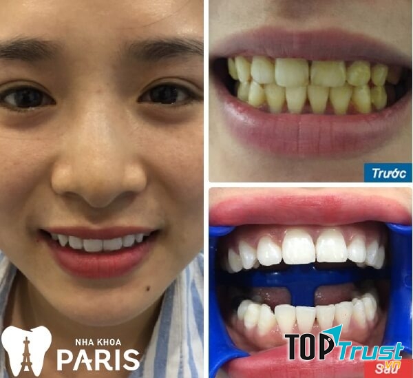 Khách hàng tẩy trắng răng tại nha khoa Paris Hải Phòng