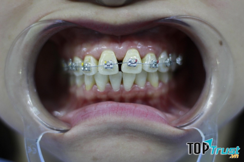 Nha khoa Bảo Ngân