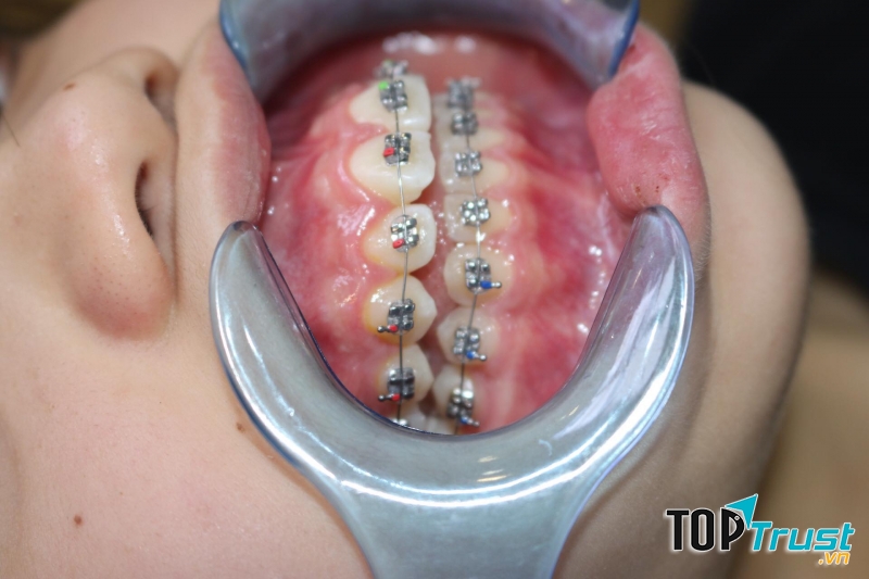 Nha khoa Bảo Ngân