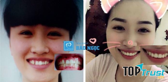 Khách hàng trước và sau niềng răng tại Nha khoa Bảo Ngọc