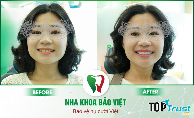 Khách hàng thay áo mới cho hàm răng tại Nha khoa Bảo Việt