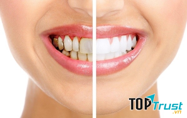 Độ trắng sáng của răng gấp 4, 5 lần sau tẩy trắng