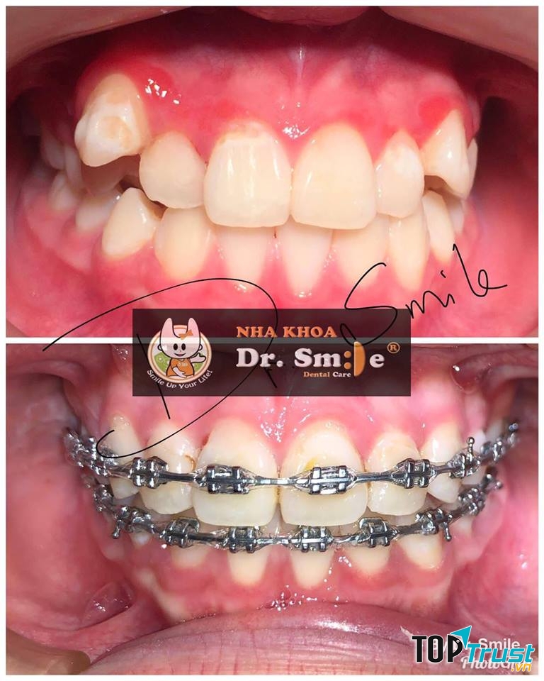 Niềng răng tại Nha khoa Dr. Smile
