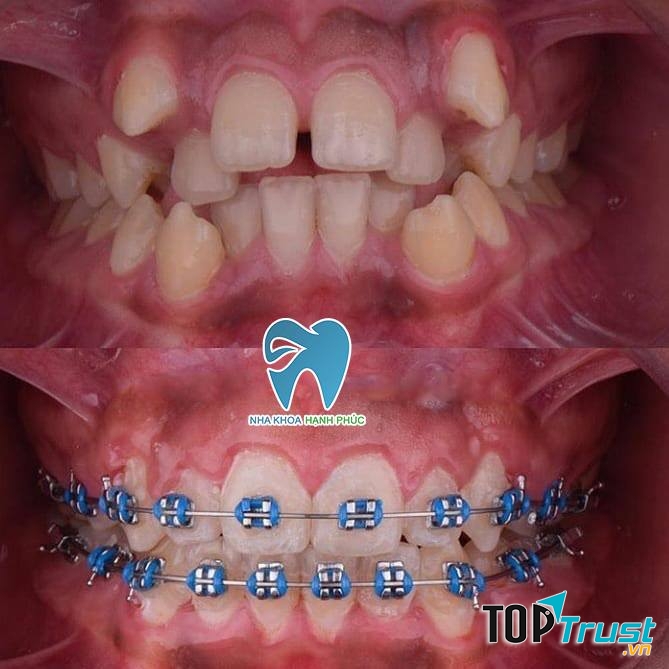 Nha Khoa Hạnh Phúc rất nhiều hình thức niềng răng tùy vào lựa chọn khách hàng