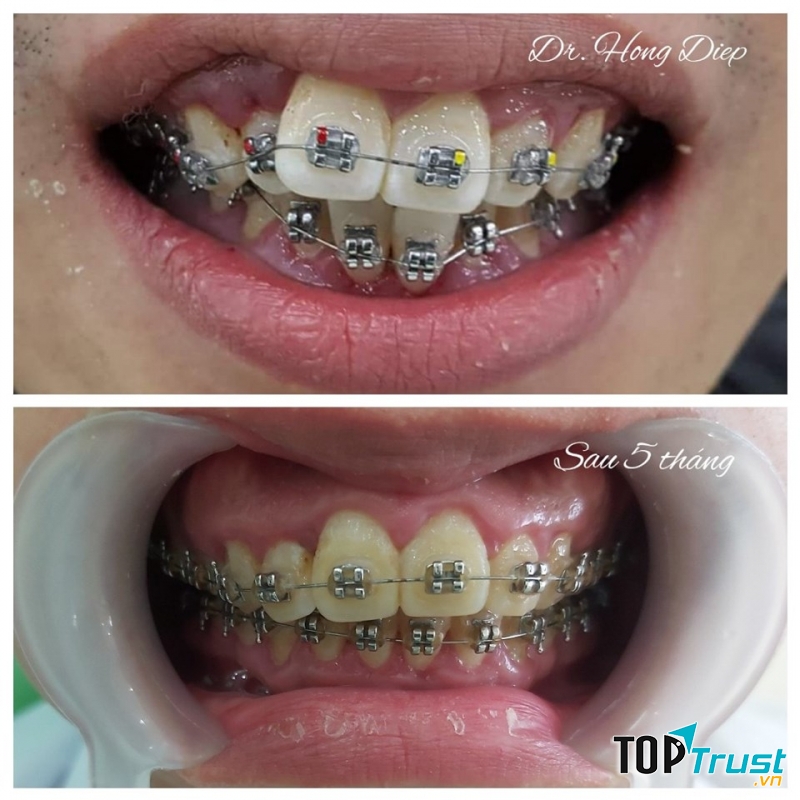 Kết quả sau 5 tháng niềng răng tại Nha khoa Hồng Điệp