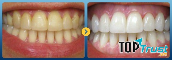 Kết quả tẩy trắng răng tại Kim