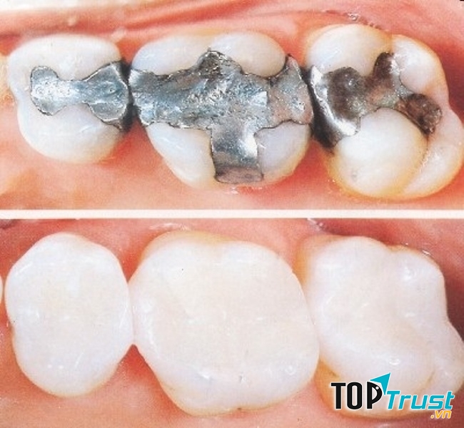 Kết quả hàn trám răng tại Nha khoa Lạc Việt