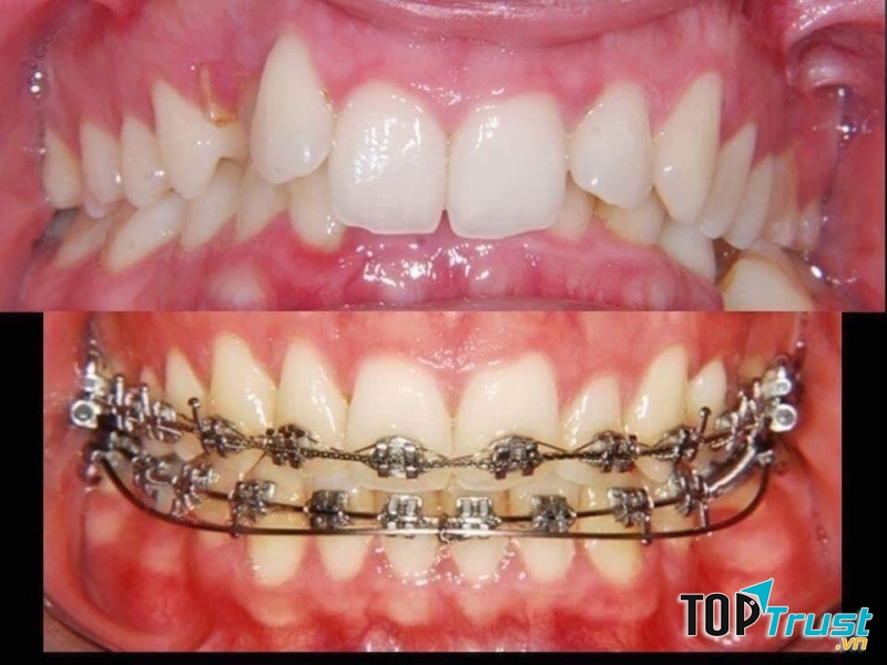 Niềng răng và điều chỉnh răng cho nụ cười đẹp hơn