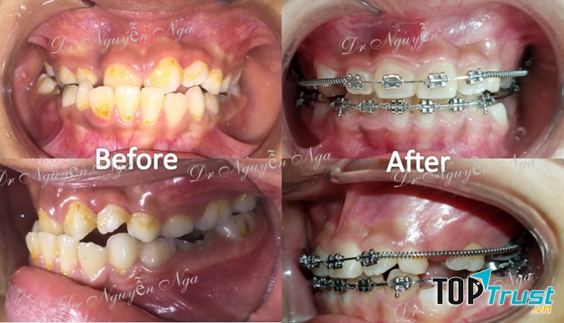 Hình ảnh trước và sau khi niềng răng tại Nha khoa Nụ cười