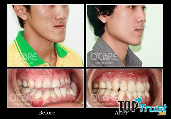 Trước và sau phẩu thuật hàm hô