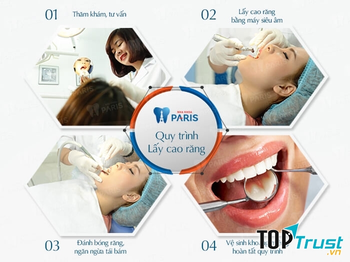 Quy trình cạo vôi răng tại Nha khoa Paris.