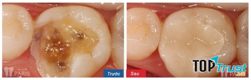 Kết quả trám răng của khách hàng tại Nha khoa Paris