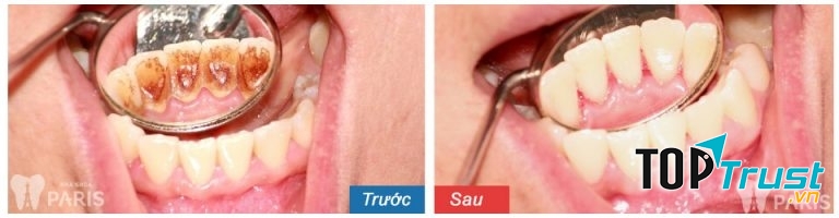 Khách hàng trước và sau lấy cao răng tại nha khoa Paris