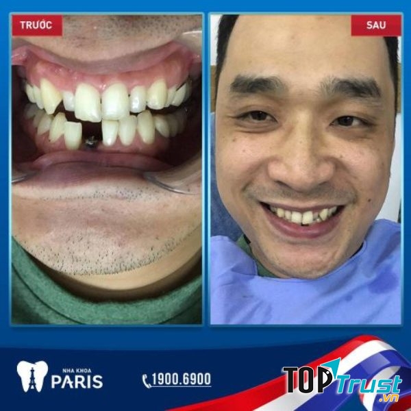 Hình ảnh khách hàng trồng răng Impland tại nha khoa Paris Đà Nẵng
