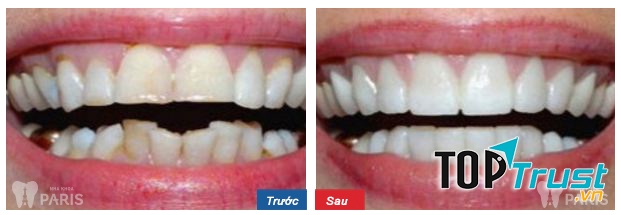 Trước và sau khi niềng răng tại nha khoa Paris