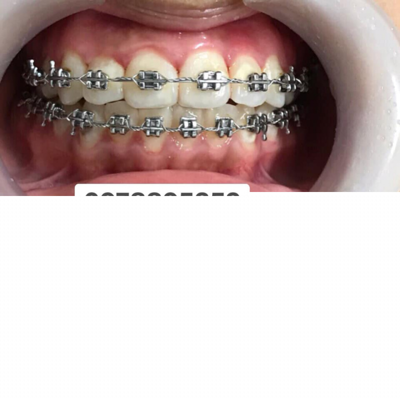 Hàm răng thay đổi rõ nét sau khi chỉnh nha tại Nha khoa Pha Lê