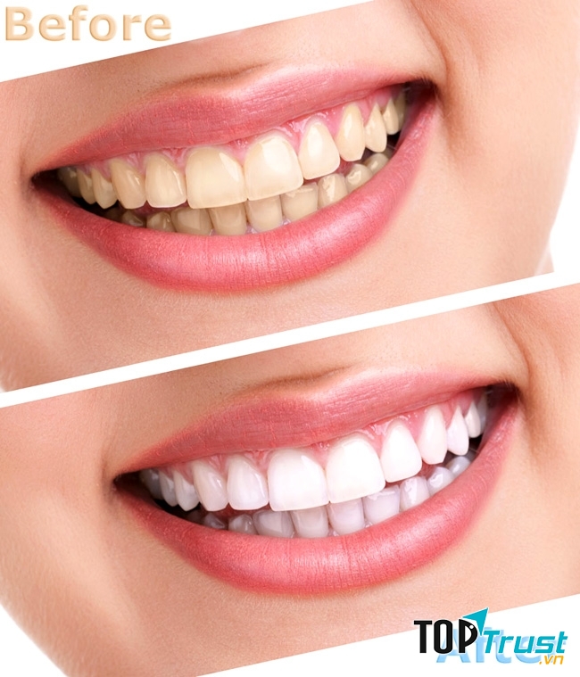 Kết quả trước và sau tẩy trắng tại Phương Nam