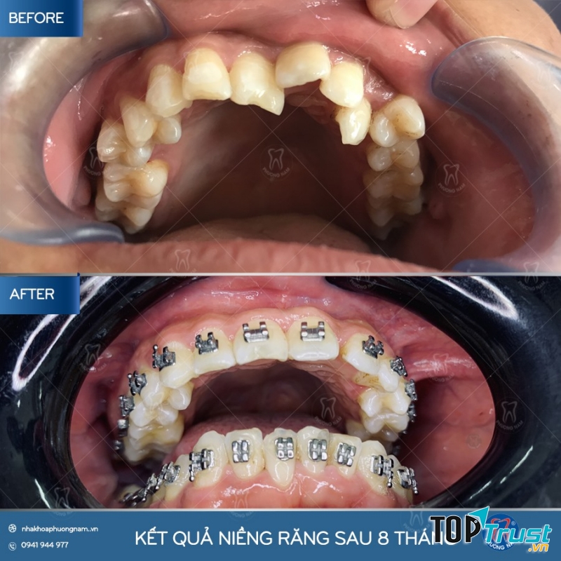 Kết quả niềng răng sau 8 tháng tại Nha khoa Phương Nam