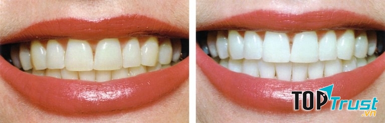 Kết quả trước và sau dùng công nghệ tẩy trắng răng tại Á Châu