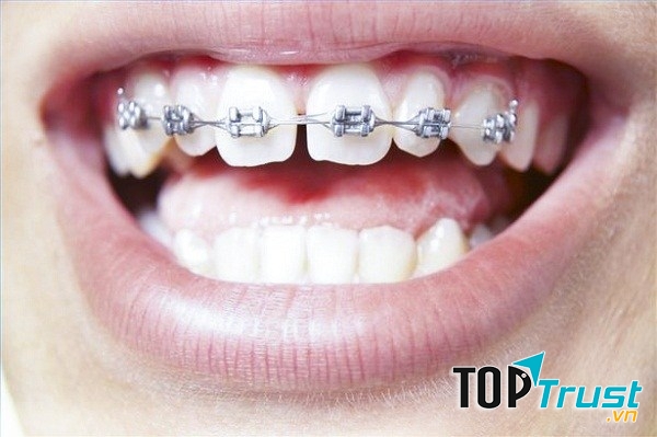 Nha khoa quốc tế Á Châu là địa chỉ niềng răng giá rẻ