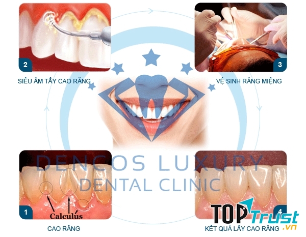 Quy trình cạo vôi răng.