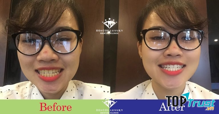 Trước – sau khi tẩy trắng răng