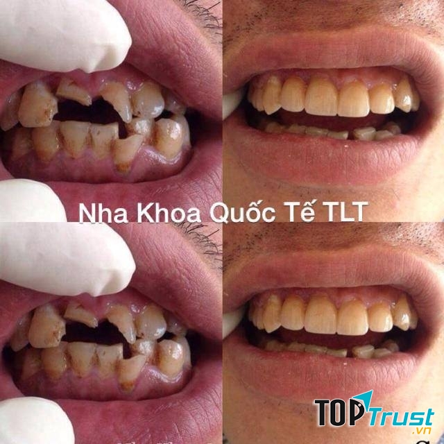 Nha Khoa Quốc Tế TLT