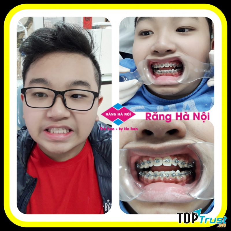 NHA KHOA RĂNG HÀ NỘI