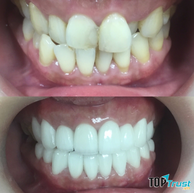 Nha Khoa Răng Sứ -  Porcelain Dentistry