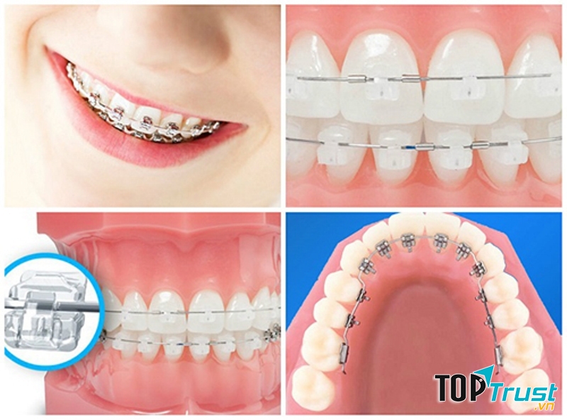 Một số kiểu niềng răng tại Nha khoa Sài Gòn Đà Nẵng