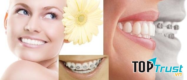 Niềng răng tại nha khoa Việt Úc