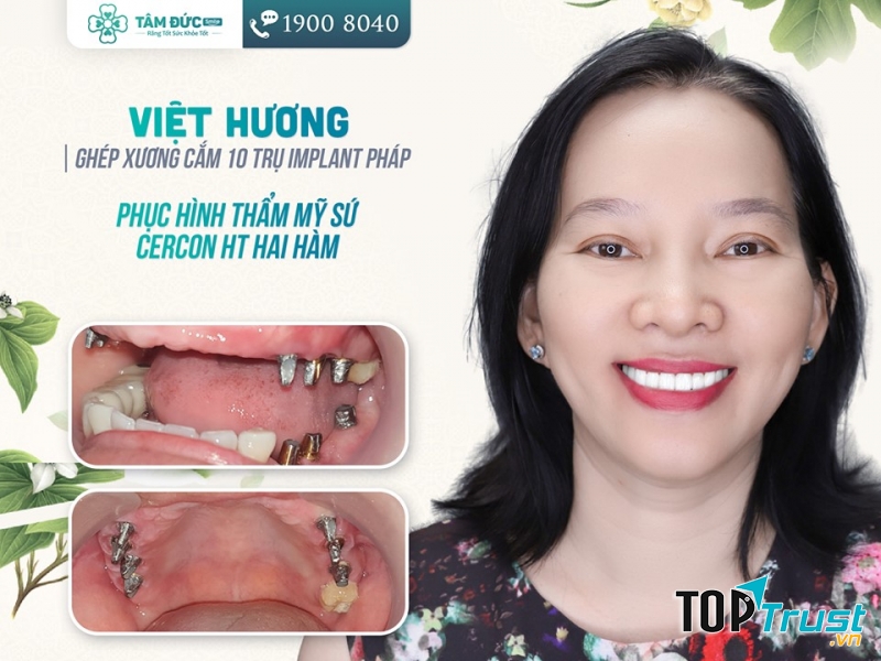 Khách hàng cắm trụ Impland tại Nha khoa Tâm Đức Smile