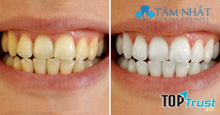 Kết quả khác biệt thấy rõ trước và sau tẩy trắng