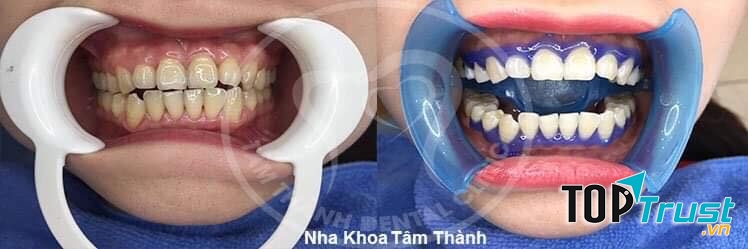 Nha Khoa Tâm Thành Tuyên Quang