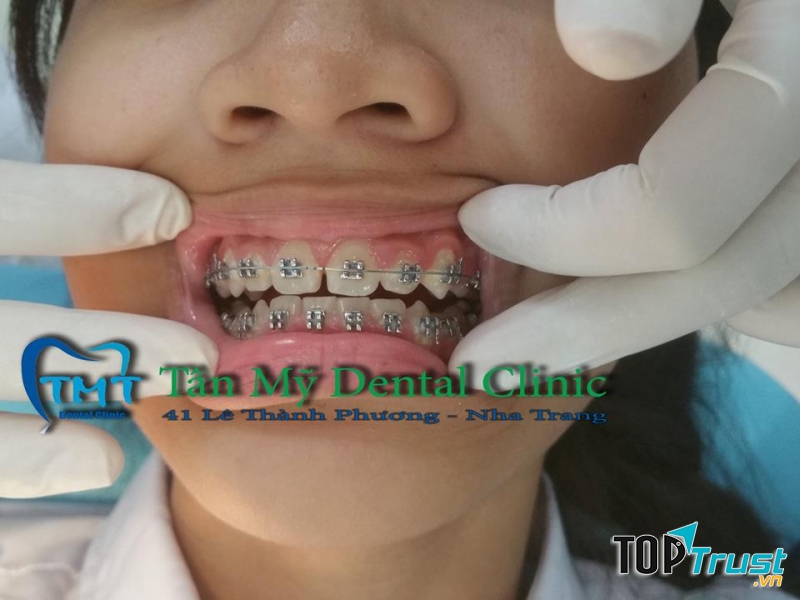 Niềng răng tại Nha khoa Tân Mỹ