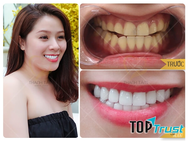 Khách hàng tẩy trắng răng tại Nha khoa Thanh Tâm