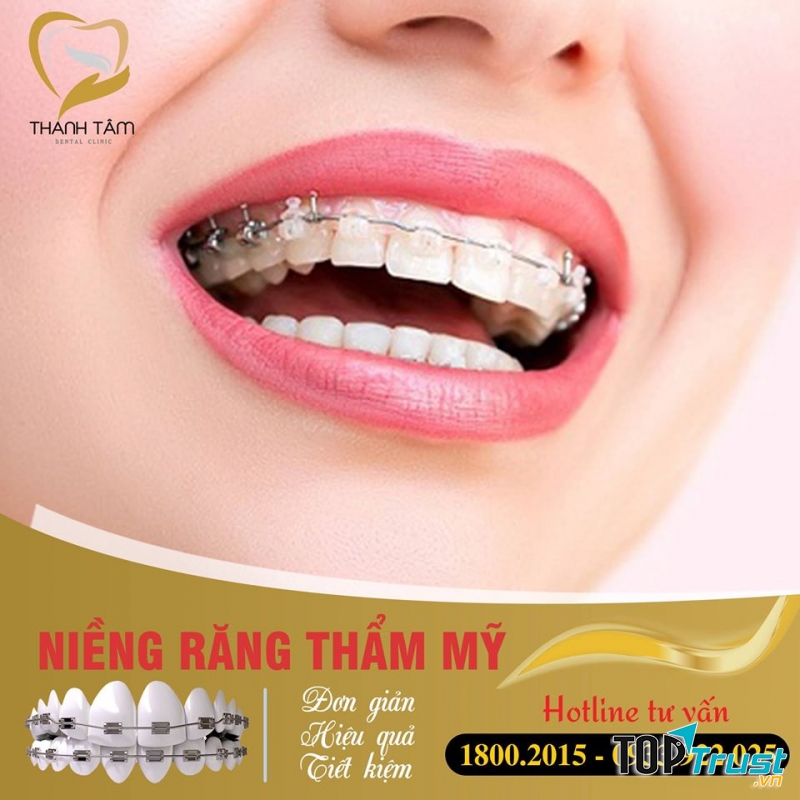 Niềng răng tại Nha Khoa Thanh Tâm