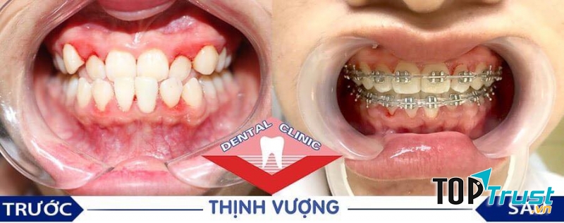 Nha Khoa Thịnh Vượng