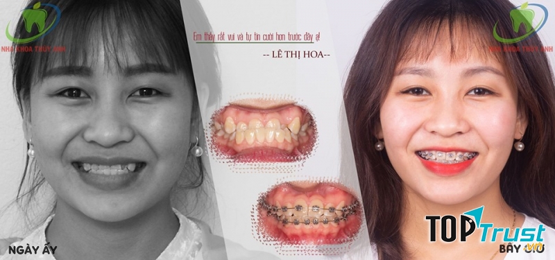Kết quả sau 6 tháng niềng răng tại Nha khoa Thùy Anh