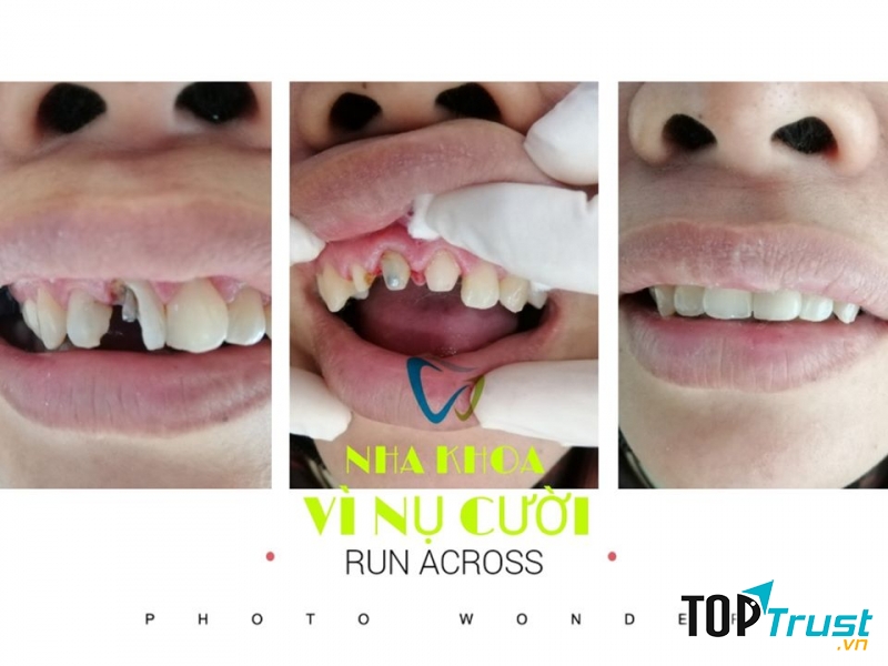 Nha Khoa Vì Nụ Cười
