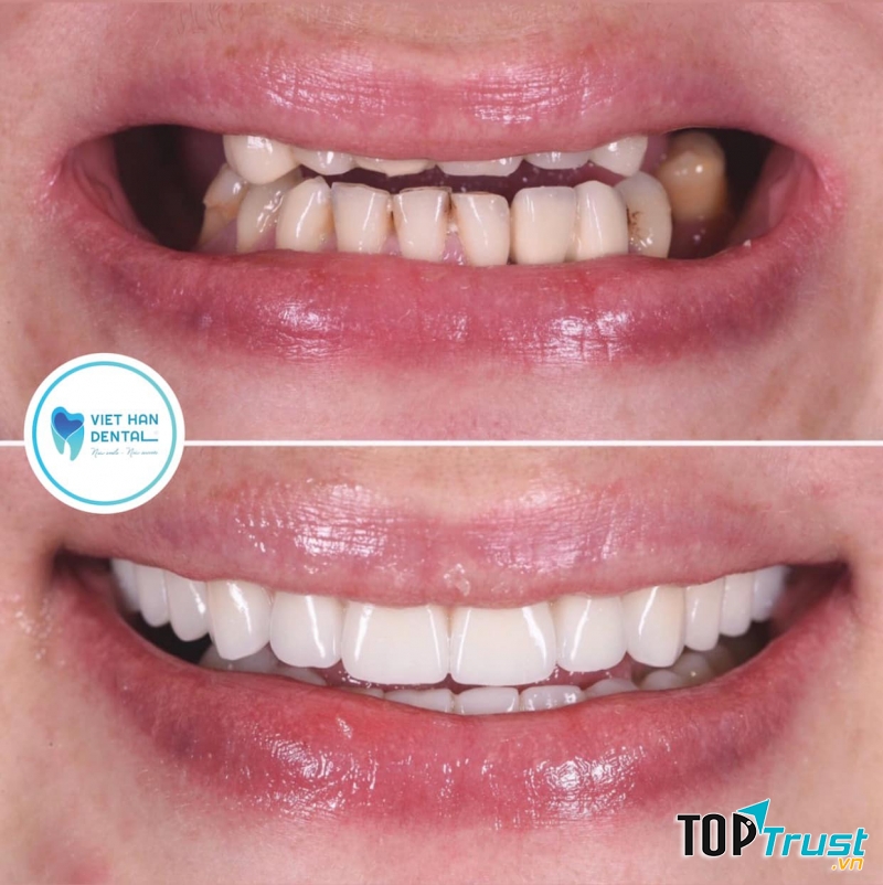 Nha Khoa Việt Hàn Nha Trang