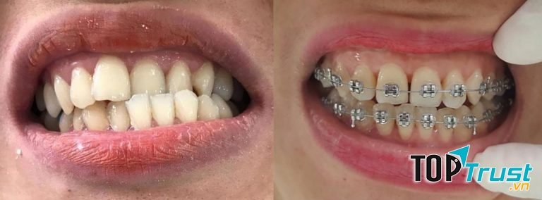 Niềng răng mắc cài tại Nha khoa Việt Khương