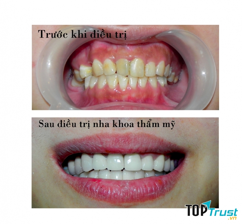 Kết quả trước và sau điều trị nha khoa thẩm mỹ
