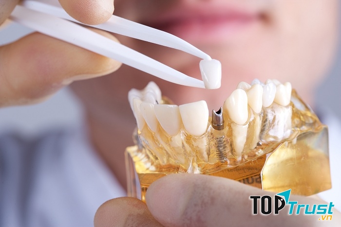 Dịch vụ trồng răng Implant tại Nha khoa Việt Pháp