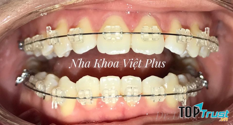 Hình ảnh niềng răng tại Nha khoa Việt Plus