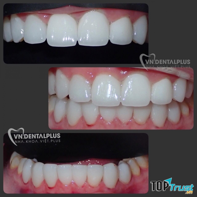 NHA KHOA VIỆT PLUS