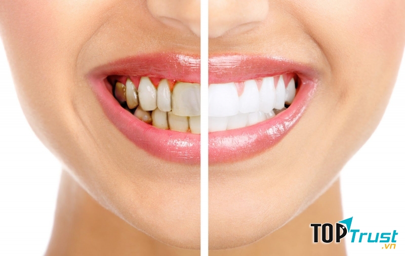 Hình ảnh răng khách hàng trước và sau tẩy trắng