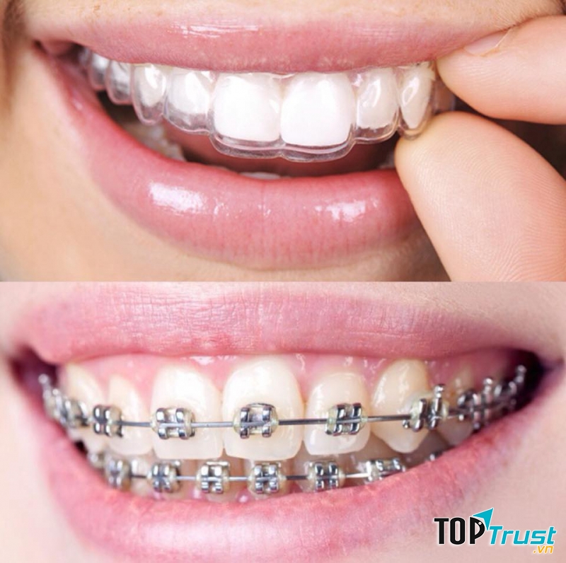 Dịch vụ niềng răng tại nha khoa Vinh