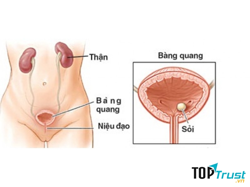 Nhiễm khuẩn đường tiết niệu